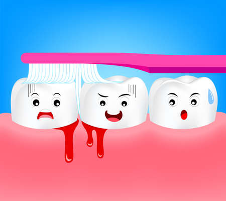 What is Gingivitis? What is Gingivitis?